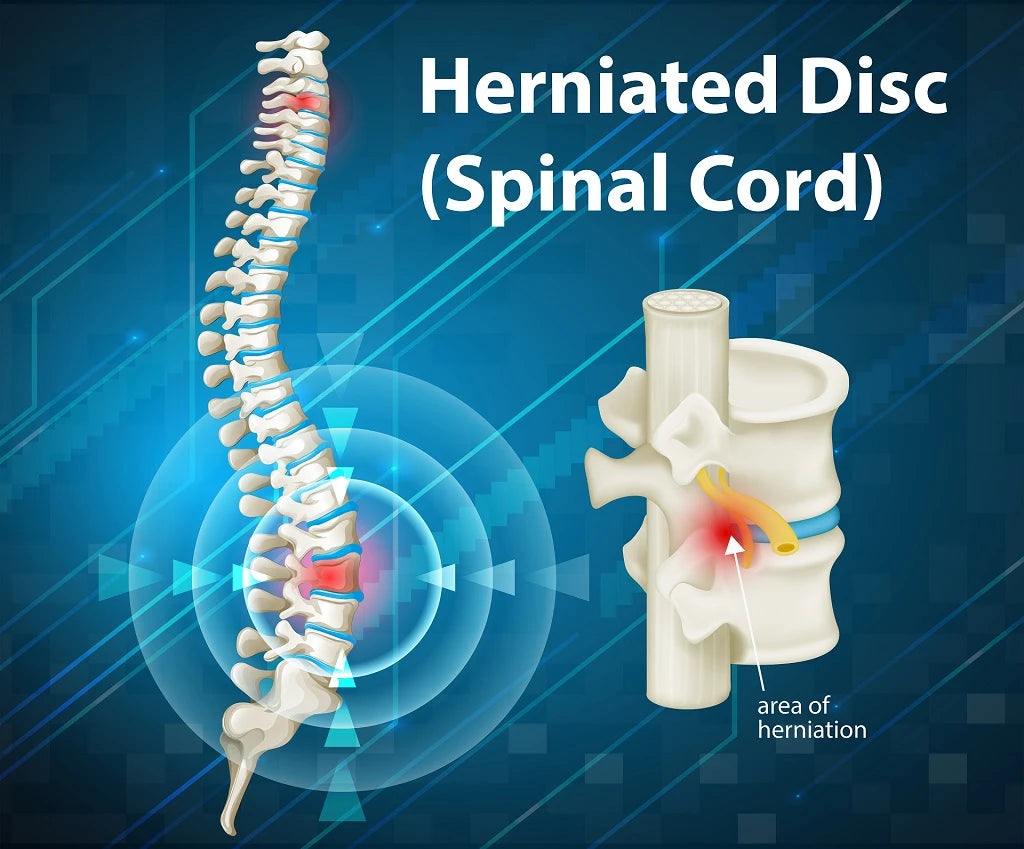 Illustration of a herniated disc area of pain.