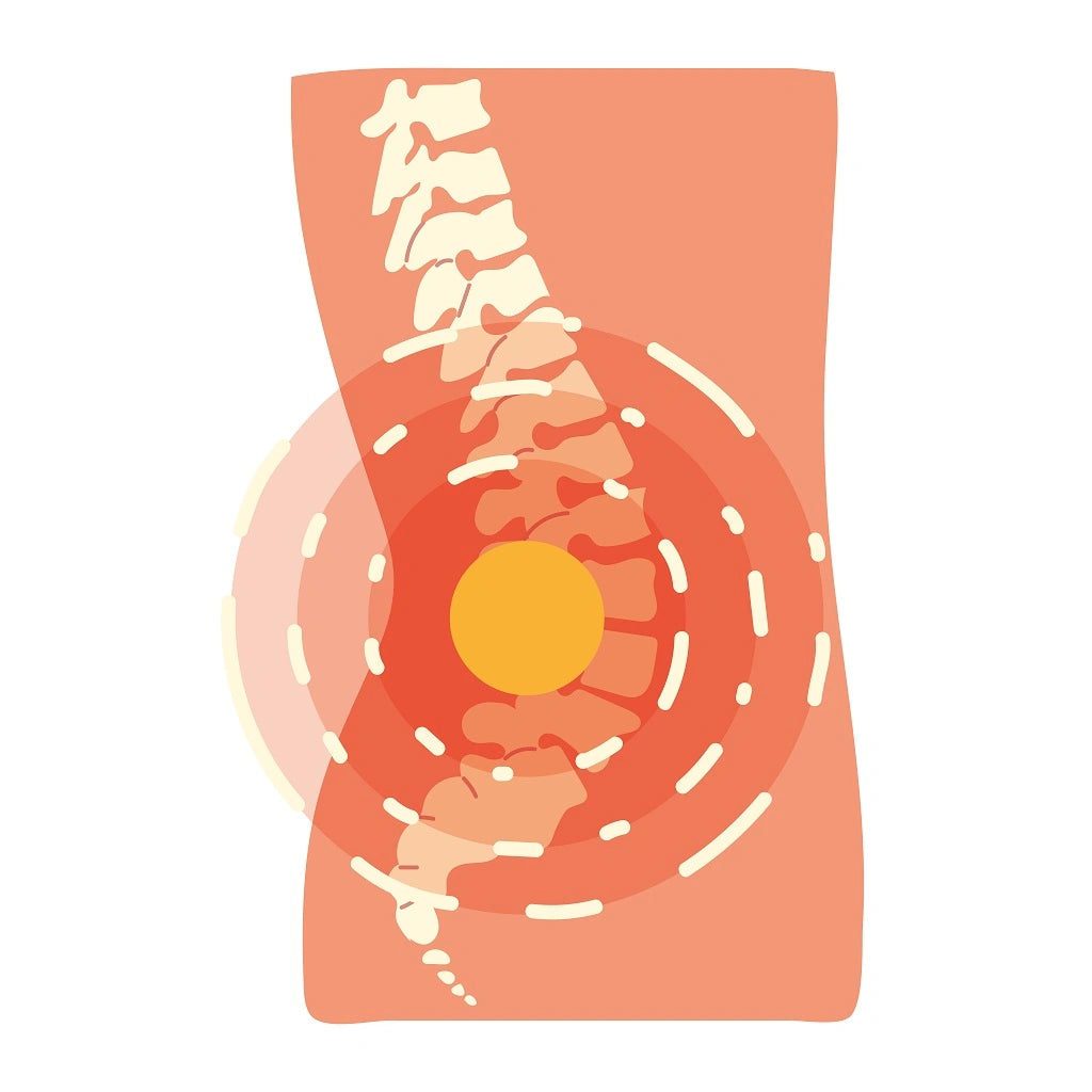 Illustration of what lumbar lordosis looks like.