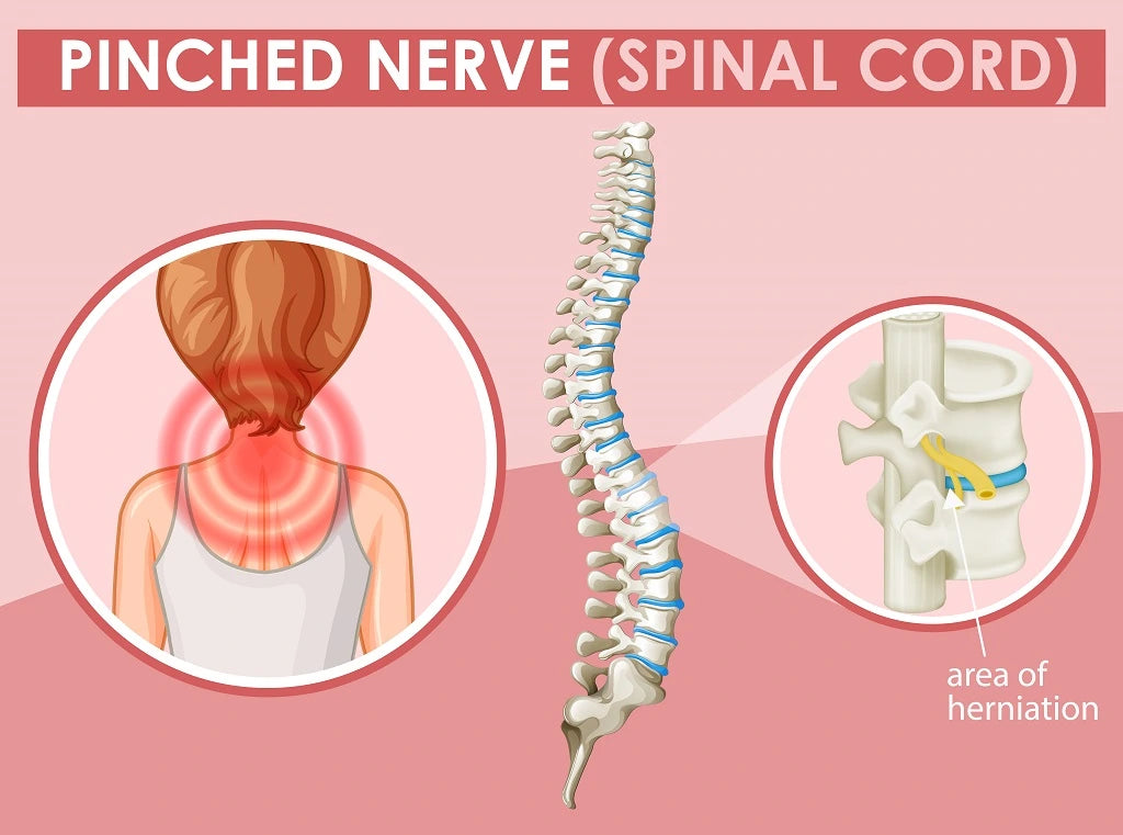 Illustration showing Pinched Nerve.