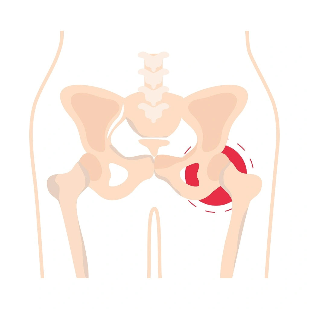 Illustration of SI joint dysfunction area of pain.