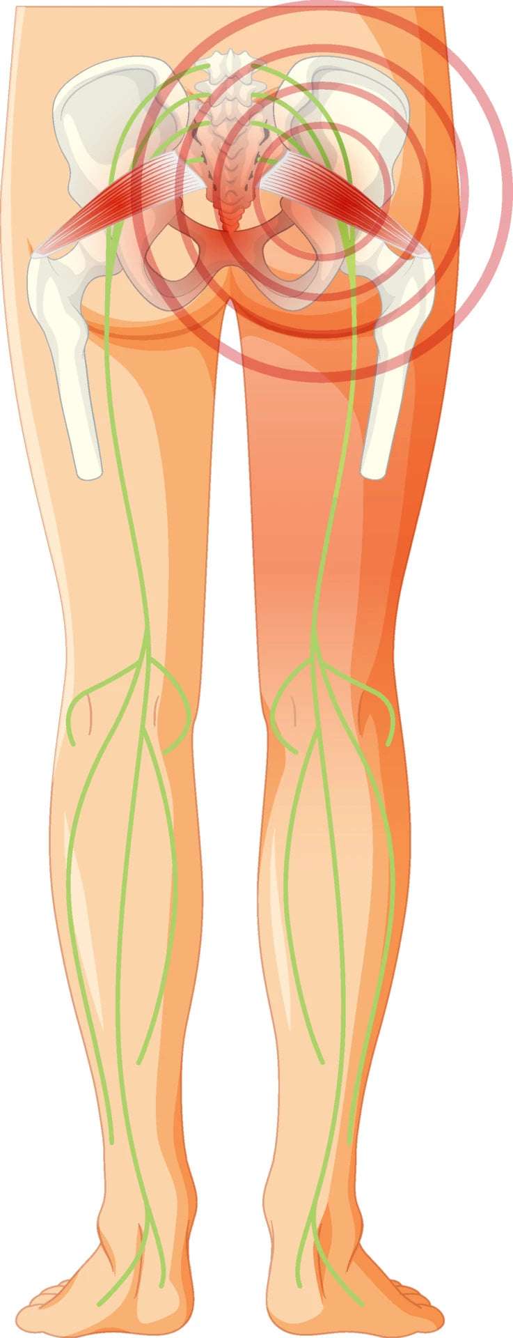 Illustration of the sciatic nerve area of inflammation.