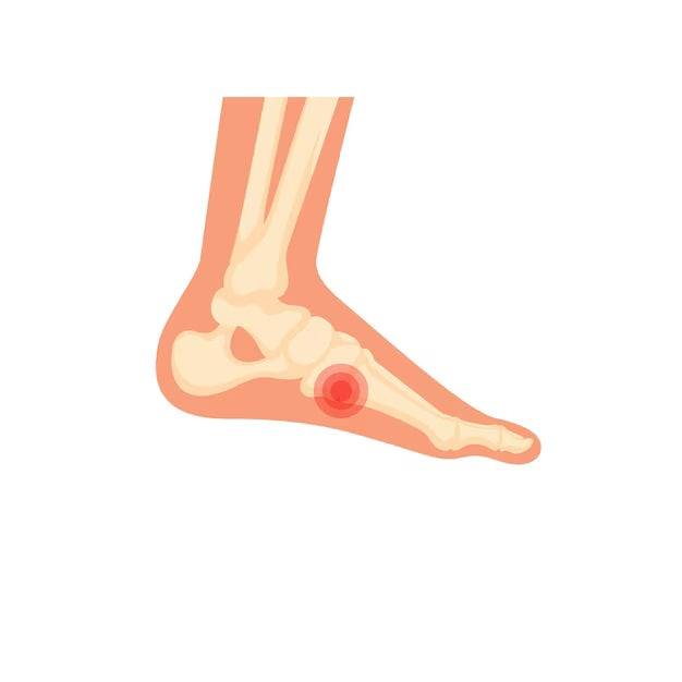 Foot with plantar fasciitis.